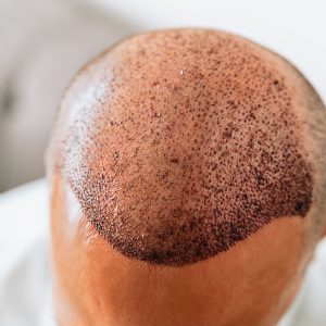 Haartransplantation FUE FUT DHI