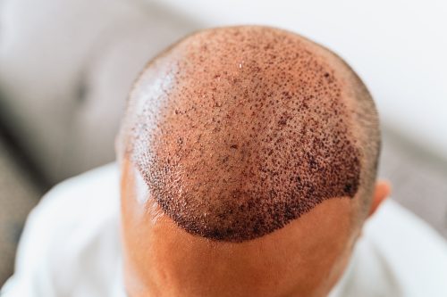 Haartransplantation FUE FUT DHI