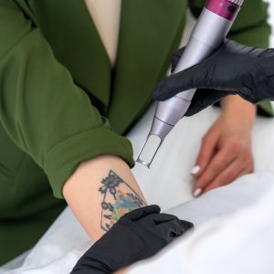 Tattooentfernung mit pico Laser