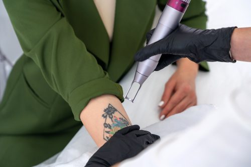 Tattooentfernung mit pico Laser