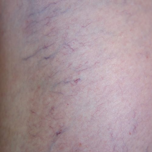 Couperose, Rosacea , Äderchen, Besenreiser : Gefäßlaser für Gesicht & Körper